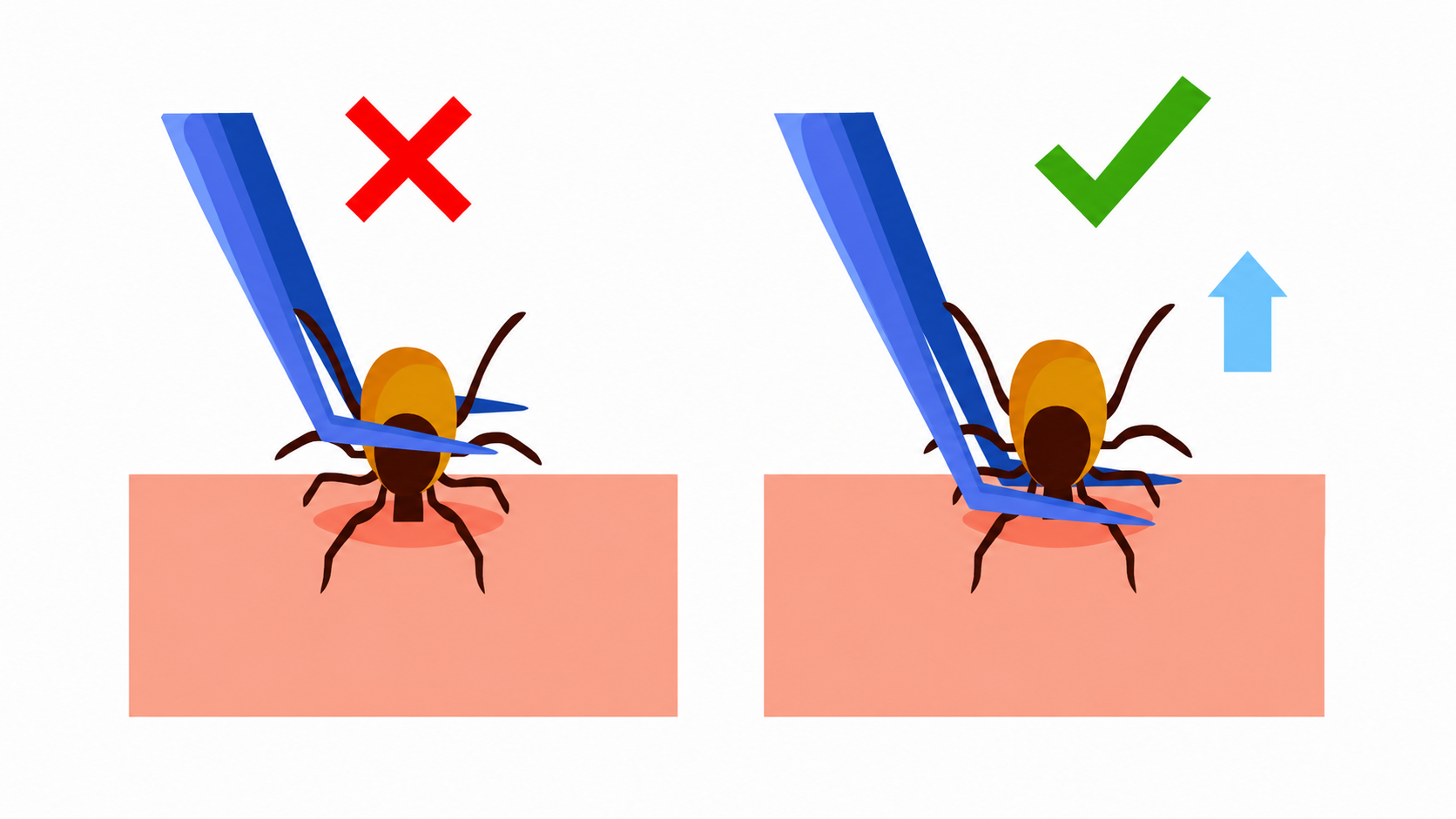 Tick safety correct removel