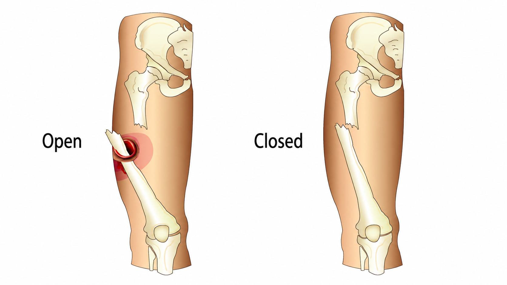 open fracture management