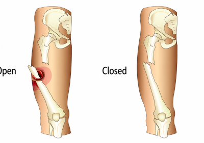 open fracture management